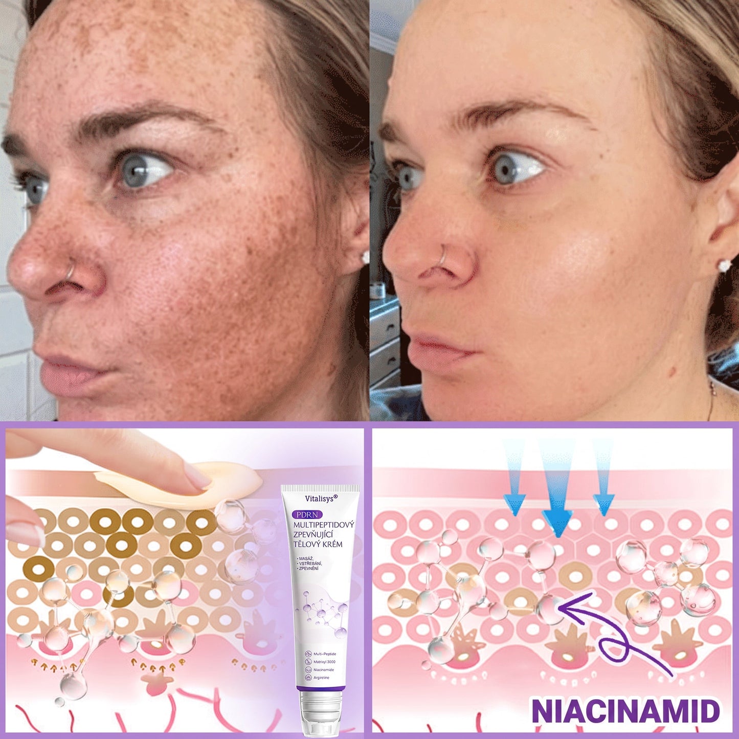 Doporučováno dermatology🥇 | 🍊Vitalisys® PDRN Multi-Peptidový masážní tělový krém – Proti stárnutí, hydratační, zpevňující, regenerační, sjednocující, proti akné a skvrnám, na odstraňování bradavic a mateřských znamének, pro úlevu při lupénce.❤️