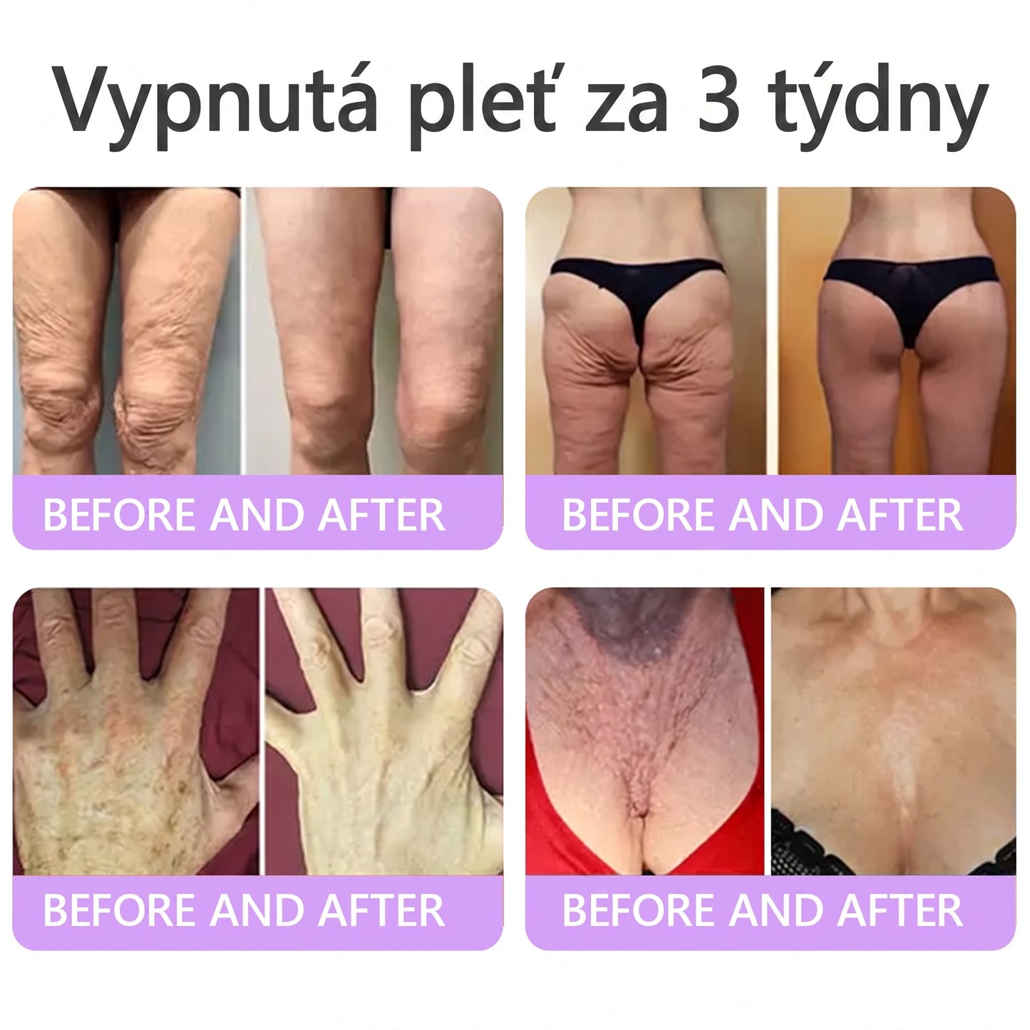 Doporučováno dermatology🥇 | 🍊Vitalisys® PDRN Multi-Peptidový masážní tělový krém – Proti stárnutí, hydratační, zpevňující, regenerační, sjednocující, proti akné a skvrnám, na odstraňování bradavic a mateřských znamének, pro úlevu při lupénce.❤️