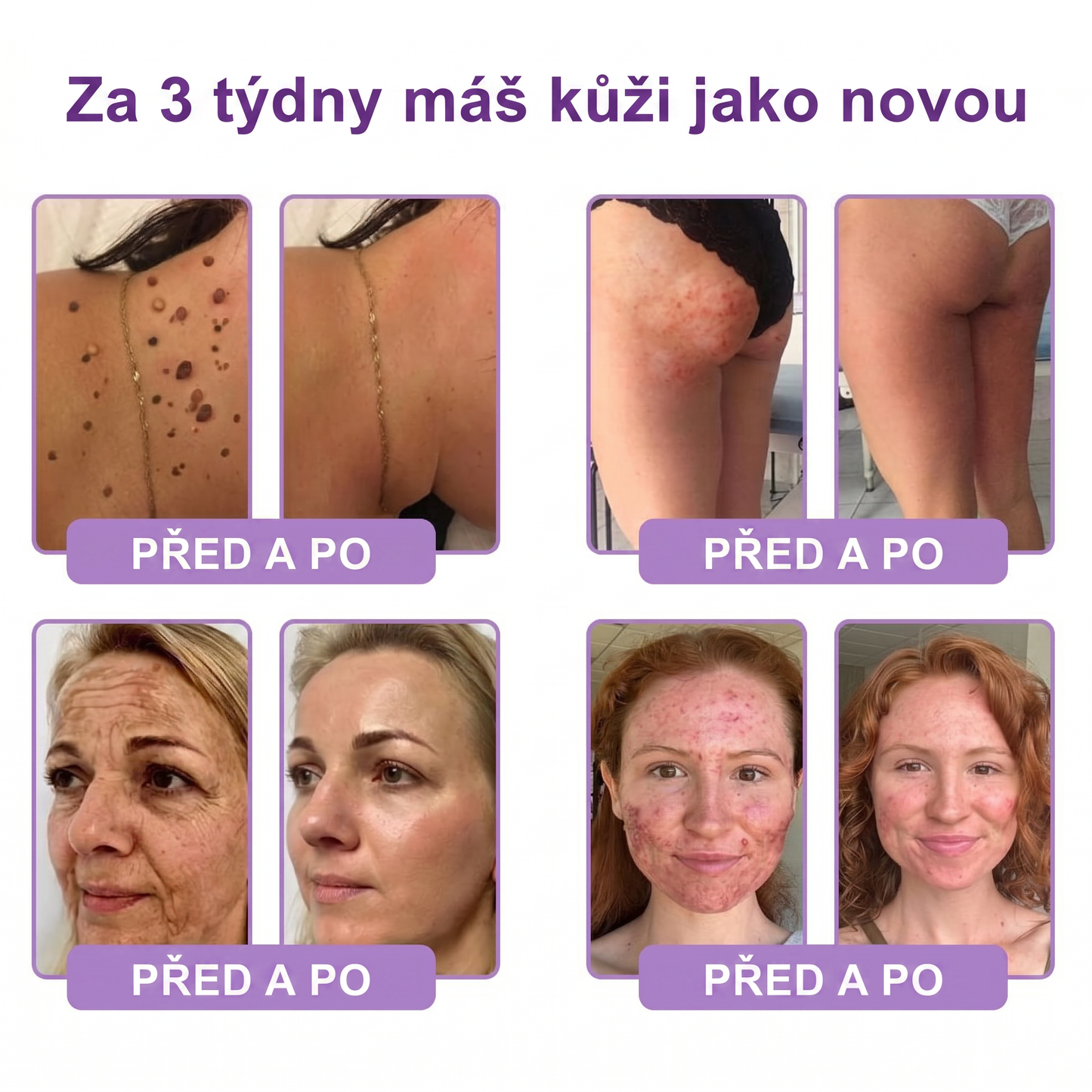 Doporučováno dermatology🥇 | 🍊Vitalisys® PDRN Multi-Peptidový masážní tělový krém – Proti stárnutí, hydratační, zpevňující, regenerační, sjednocující, proti akné a skvrnám, na odstraňování bradavic a mateřských znamének, pro úlevu při lupénce.❤️