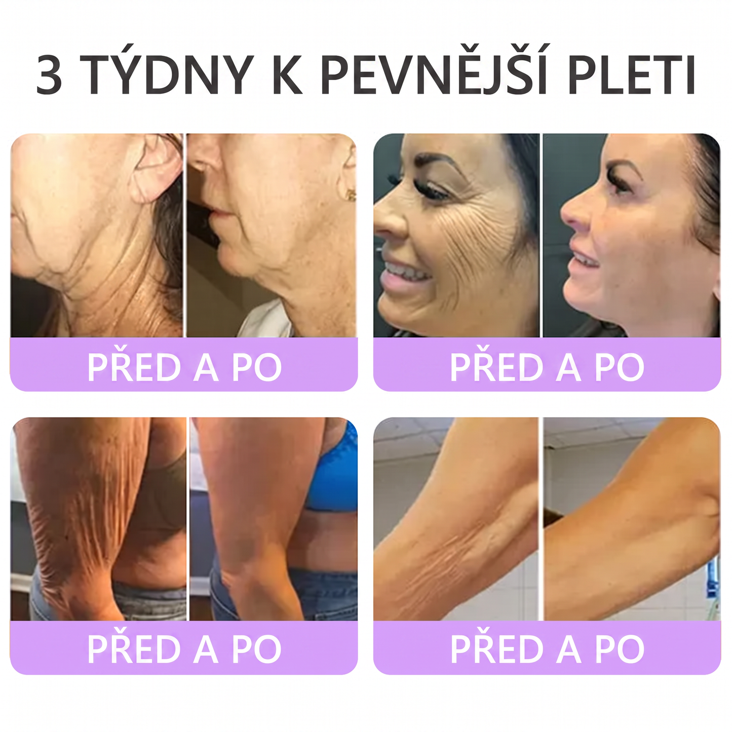 Doporučováno dermatology🥇 | 🍊Vitalisys® PDRN Multi-Peptidový masážní tělový krém – Proti stárnutí, hydratační, zpevňující, regenerační, sjednocující, proti akné a skvrnám, na odstraňování bradavic a mateřských znamének, pro úlevu při lupénce.❤️