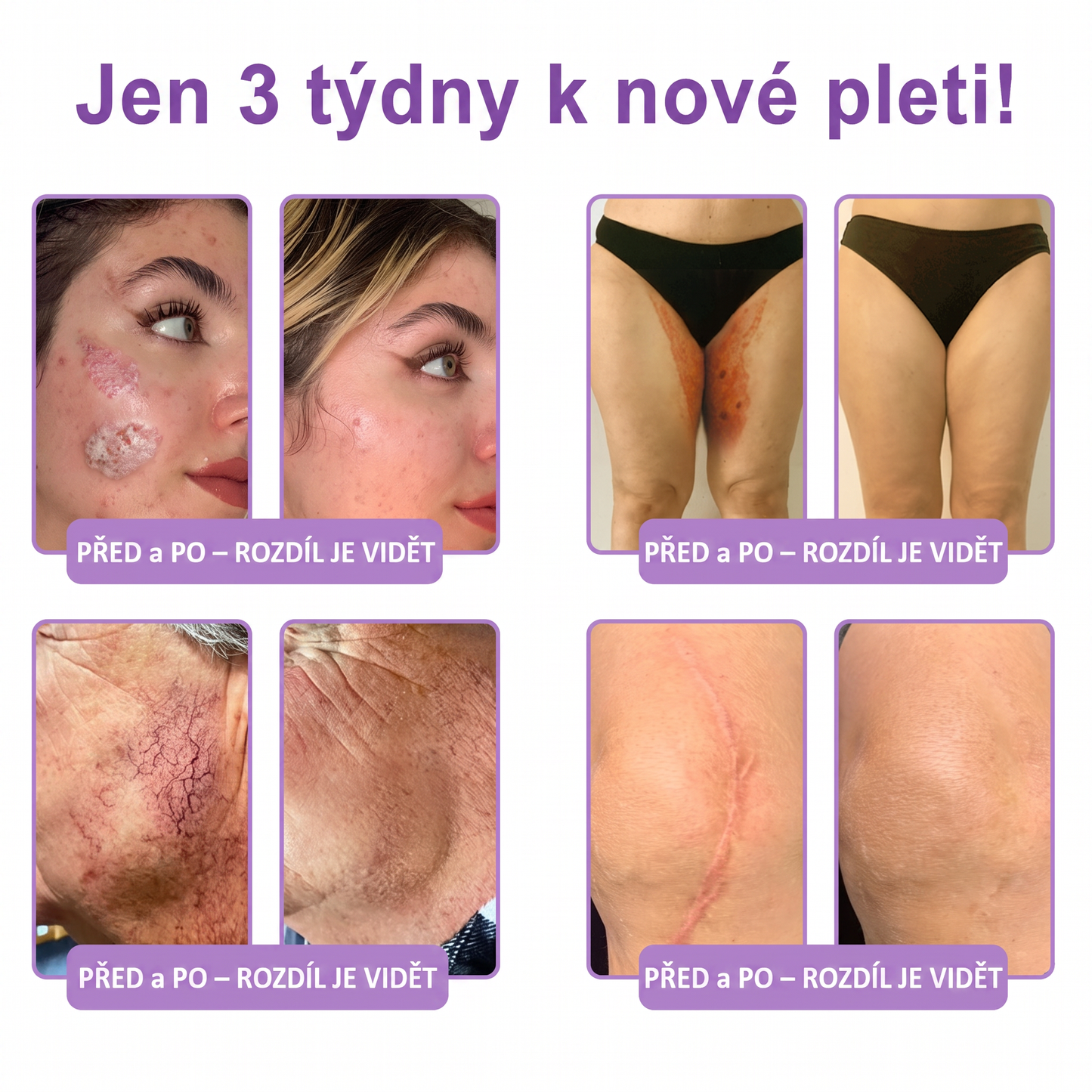 Doporučováno dermatology🥇 | 🍊Vitalisys® PDRN Multi-Peptidový masážní tělový krém – Proti stárnutí, hydratační, zpevňující, regenerační, sjednocující, proti akné a skvrnám, na odstraňování bradavic a mateřských znamének, pro úlevu při lupénce.❤️